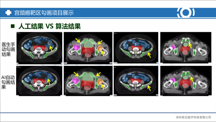 Live回顾 | 视见医疗科技研发总监王少彬：宫颈癌放疗精准临床靶区勾画