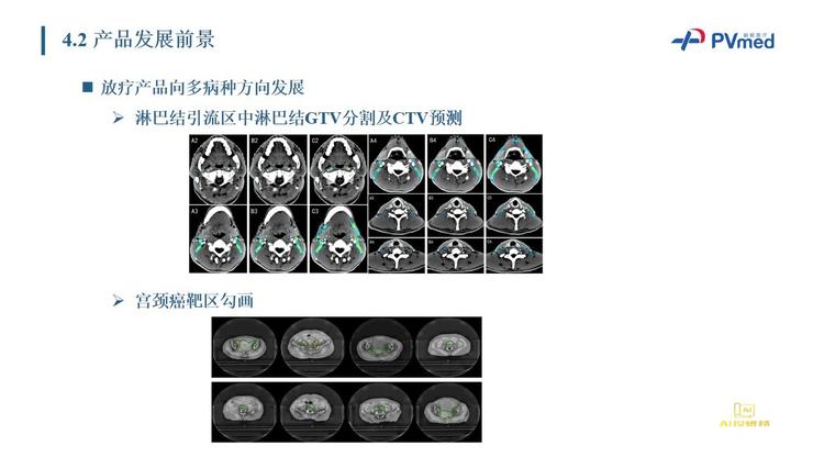 Live回顾 | 柏视医疗创始人：从AI入手，如何解决鼻咽癌放疗靶区勾画的临床痛点？