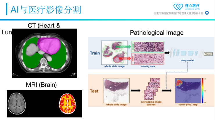 Live回顾 | 连心医疗朱森华博士：从AI切入，连心如何做好放疗智能靶区勾画？